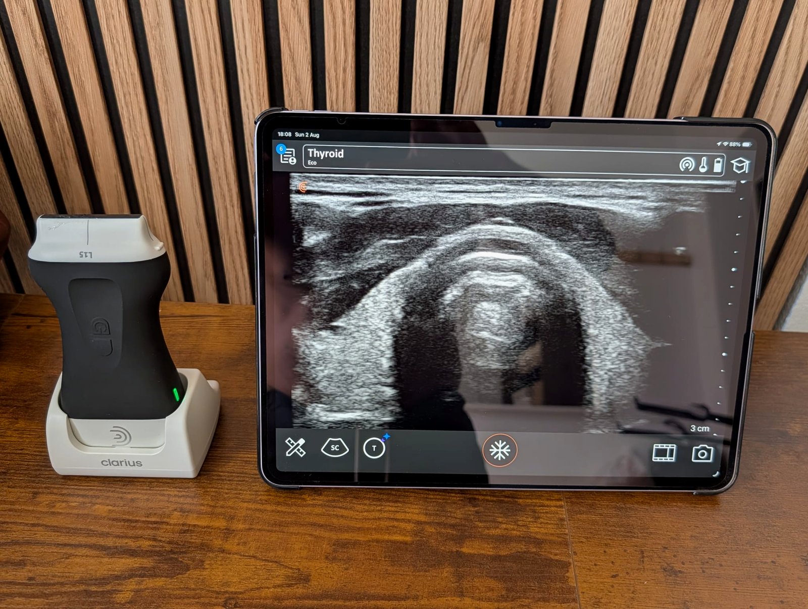 Ultrasound probe on its dock beside a tablet showing a live thyroid scan