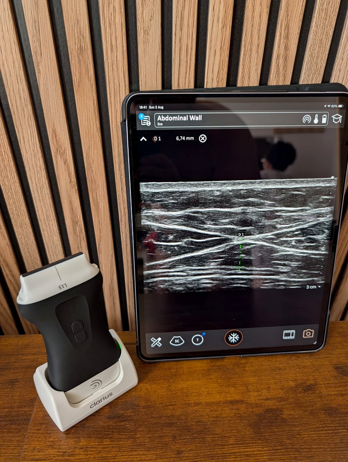 Ultrasound probe beside a tablet showing an abdominal wall scan with a caliper measurement on screen